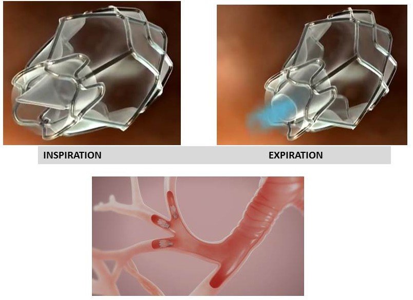 Figure 3. A schematic representation of an endobronchial valve during inspiration (valve shut)